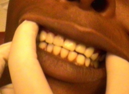 After gum diseased